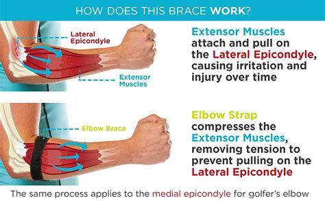 Pickleball: Tennis Elbow (Lateral Epicondylitis) – CoreNewport