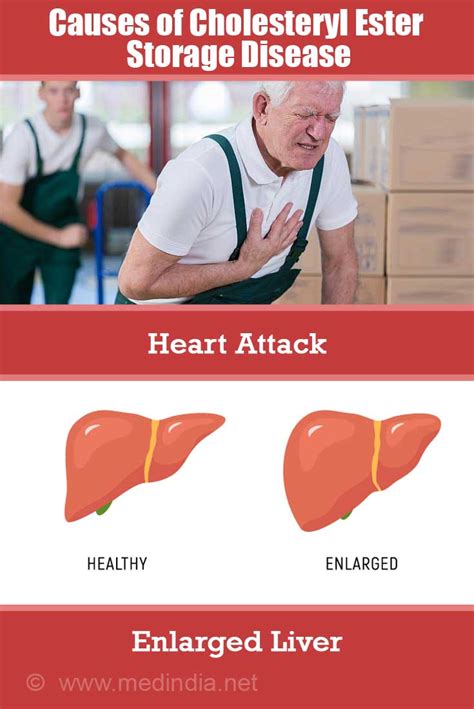 Cholesteryl Ester Storage Disease - Causes, Symptoms, Diagnosis ...