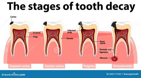 Infographic Dental Caries Stages Of Tooth Decay Stock Illustration | My XXX Hot Girl