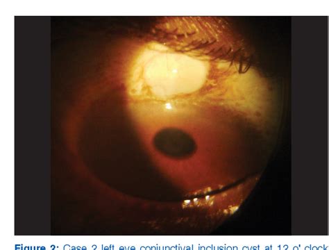 Figure 1 from Excision of post small incision cataract surgery ...