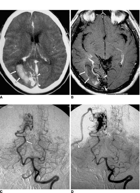 Initial radiologic studies of an AVM in a 41-year-old man with sudden ...