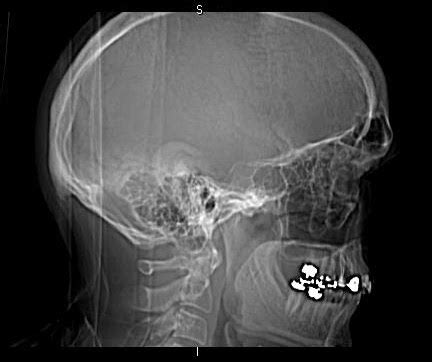 My CranioFacial Surgery: Before and After Pictures - Revisited