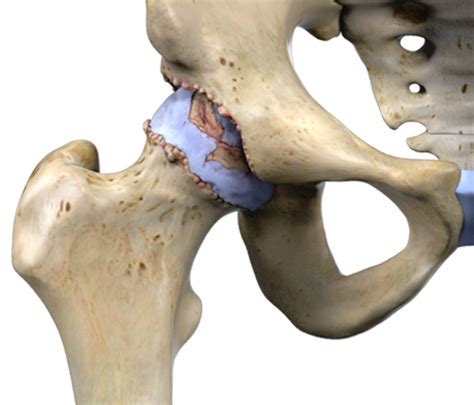 What Is Osteoarthritis.. - Ashmore Osteopathic GroupAshmore Osteopathic Group