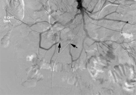 Pre-operative mesenteric angiogram. Whereas the celiac and inferior... | Download Scientific Diagram