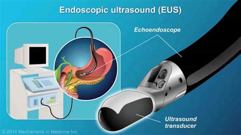 EUS defined, EUS procedure explained & EUS procedure risks