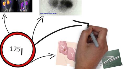 Iodine-125 - Radioisotope in Medicine (By Tammy Sortwell) - YouTube