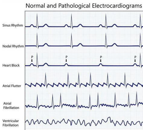 Abnormal ECG - MEDizzy