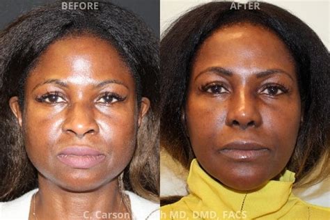 African American Rhinoplasty Atlant, GA | Radiance Surgery and Aesthetic Medicine