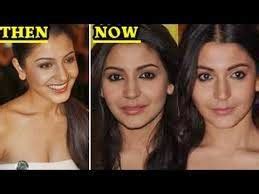 Plastic Cosmetic Surgry: Anushka Sharma: Plastic Surgery gone Wrong