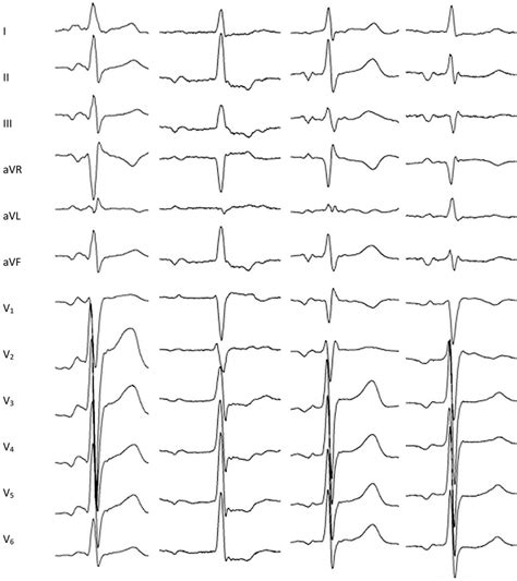 Representative examples of the P-waves morphology during para-Hisian ...