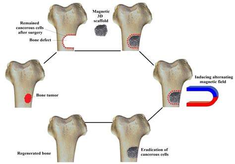 Multifunctional Bone Scaffolds: From Regeneration to Bone Cancer Therapy