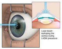 Myopia Surgery in Chennai | ID: 7861412233