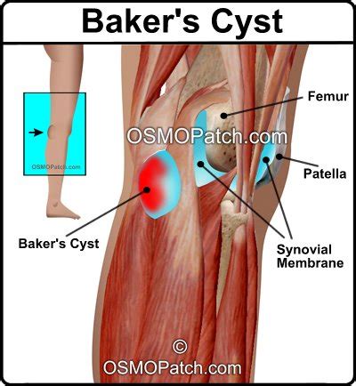 Synovial Cyst Size Chart