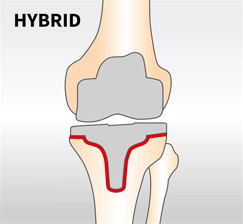 The artificial Knee Joint - ARTIQO Endoprothetik