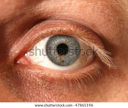 Close Eye Birthmark Stock Photo 47865196 - Shutterstock