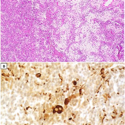 Pathological slides of central giant cell granuloma A hematoxylin and ...