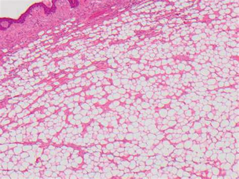 Lipoma Histology