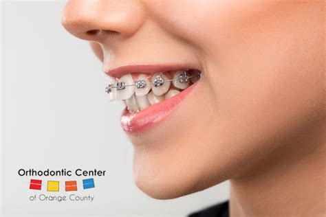 Orthodontists and Braces in OC | Braces on Crooked Teeth