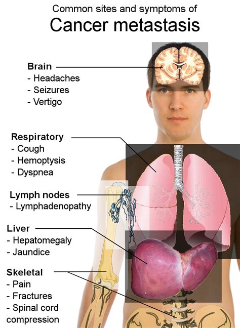 File:Symptoms of cancer metastasis.svg - New World Encyclopedia