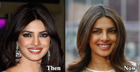 Priyanka Chopra Lip Job