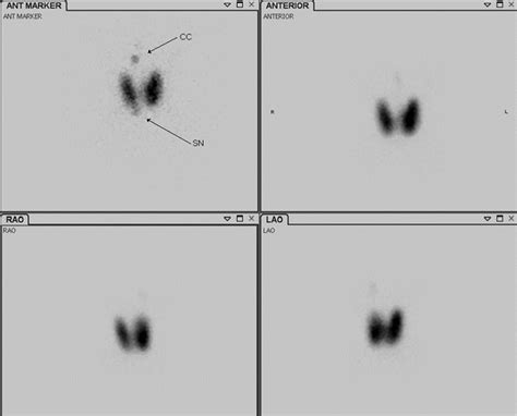 Graves Disease Thyroid Scan