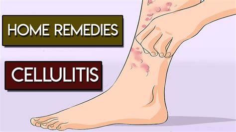 Home Remedies for Cellulitis Skin Infection - YouTube