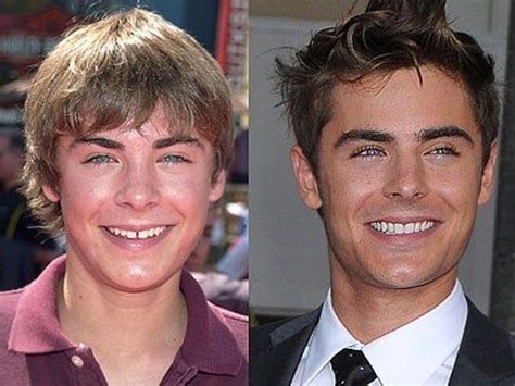 Zac Efron - Before/After Celebrities With Braces, Celebrities Then And Now, Celebrities Before ...