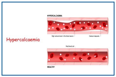 Hypercalcemia - Calaamadaha, Sababaha, ogaanshaha & Daaweynta