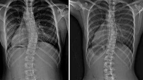 Thoracic Dextroscoliosis and Thoracolumbar Dextroscoliosis