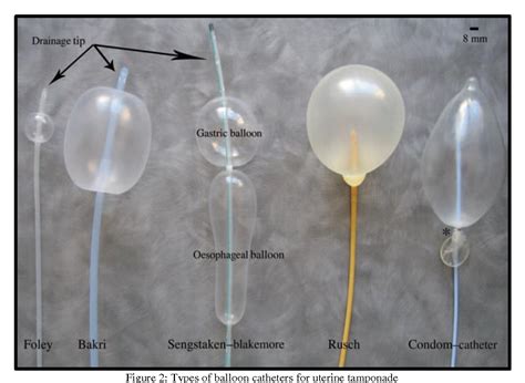 Figure 2 from Bakri balloon for the management of placenta previa | Semantic Scholar