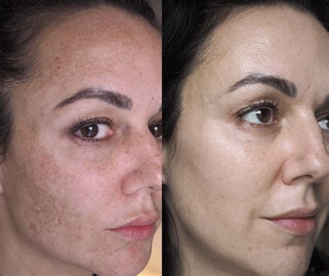 Hydroquinone Before And After Black Skin