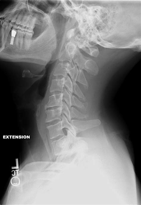 File:Cervical Xray Extension.jpg - Wikimedia Commons