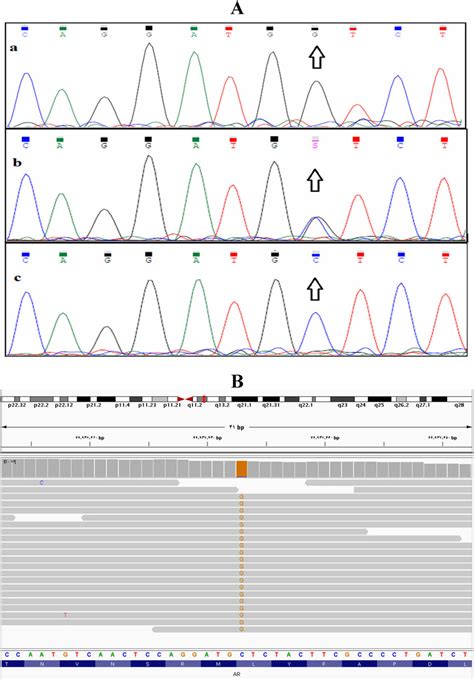 (A) The electropherogram sequencing identified c.2287C > G variant ...