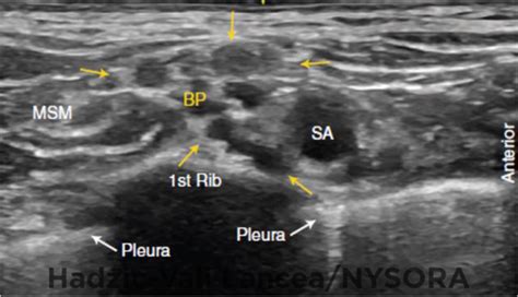 Ultrasound-Guided Supraclavicular Brachial Plexus Block - NYSORA The New York School of Regional ...