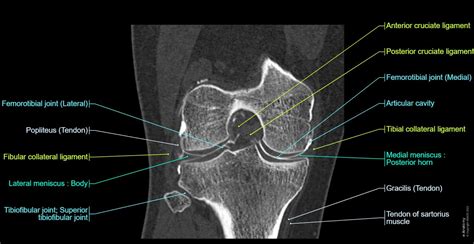 Anatomy of the knee (CT arthrography) | e-Anatomy