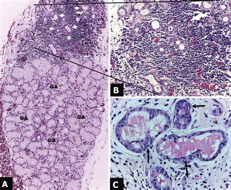 Necrotizing Sialometaplasia Histology