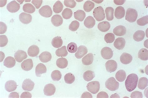 Free picture: photomicrograph, blood smear, plasmodium malariae ...