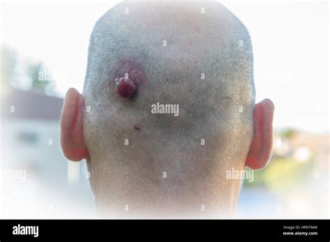 Pyogenic Granuloma High Resolution Stock Photography and Images - Alamy