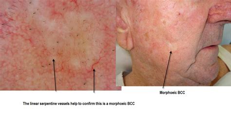 Dermoscopy Made Simple: Basal Cell Carcinoma