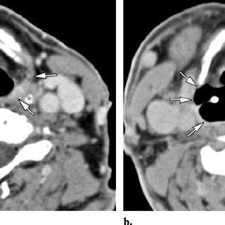 Normal hypopharynx. (a) Axial CT scan obtained during quiet respiration... | Download Scientific ...