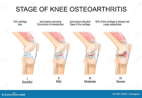 Stages Of Osteoarthritis Of The Knee Vector Illustration | CartoonDealer.com #137401330