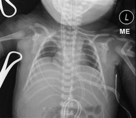 Cureus | Infant with Clinical Evidence of Pulmonary Hypoplasia: A Case Report