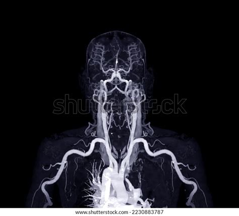 Brachial Arteries Arm Upper Extremity Bone Stock Illustration ...