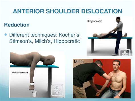 Anterior Shoulder Dislocation Reduction