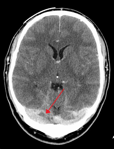 Dural Venous Sinuses Anatomy Radiology