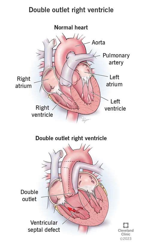 Double Outlet Right Ventricle (DORV)