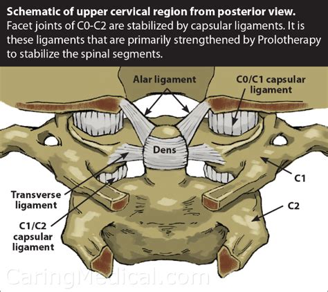 Atlantoaxial Instability