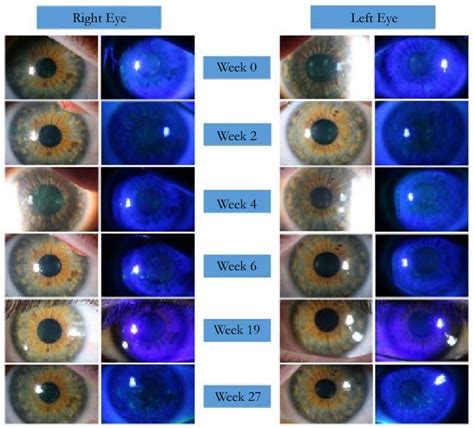 Figure 1 from Steroid Sparing Symptomatic Control of Thygeson’s Superficial Punctate Keratitis ...