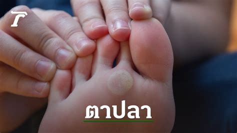 What causes "bunion" and how to prevent and treat it easily by yourself ...