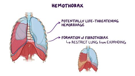 Hemothorax: Clinical sciences - Osmosis Video Library